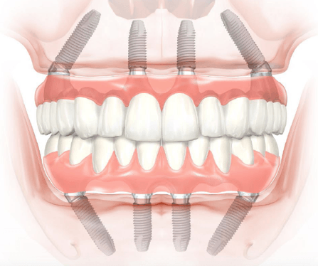 aal-on-4-dental-implants