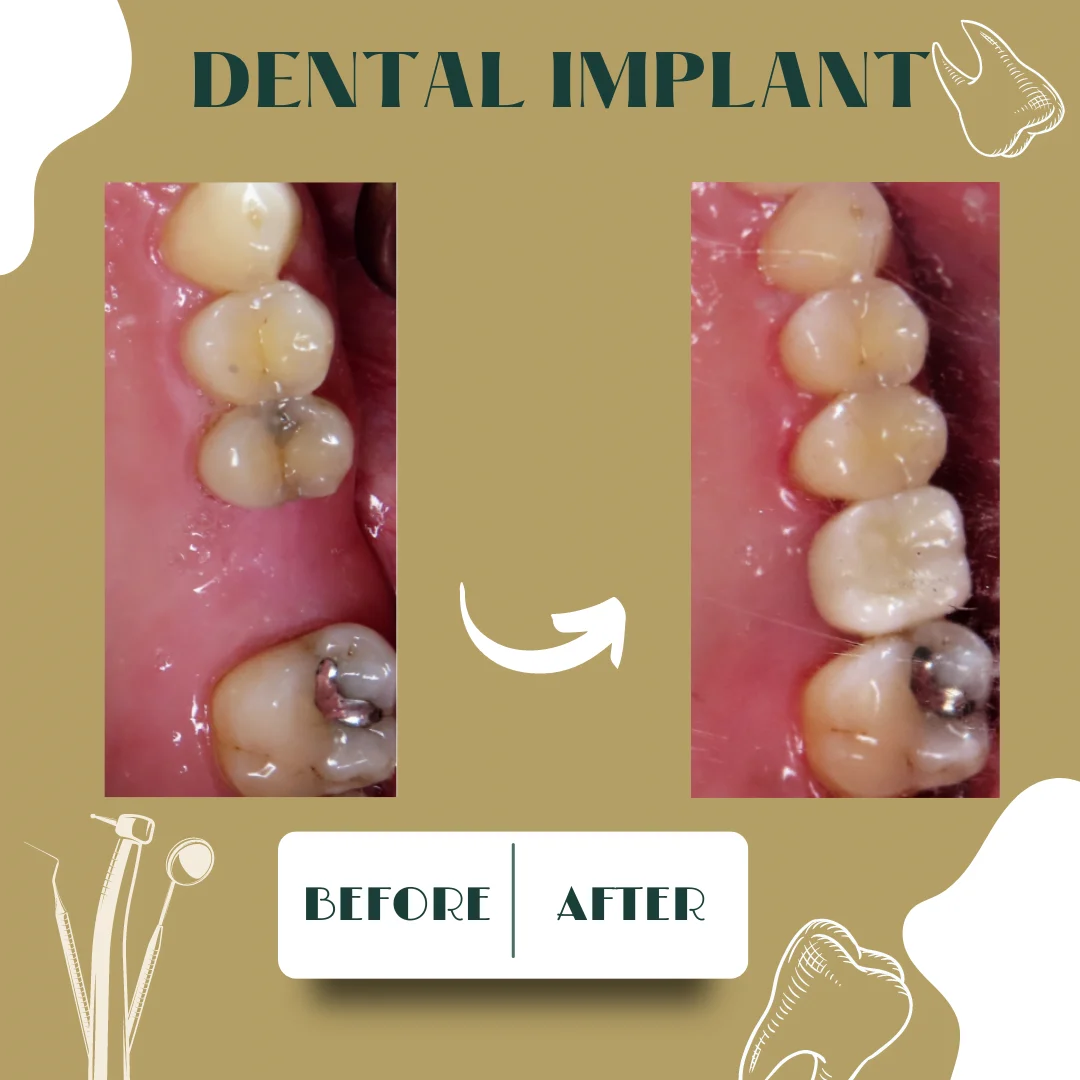 Caso clínico dental 3, antes y después