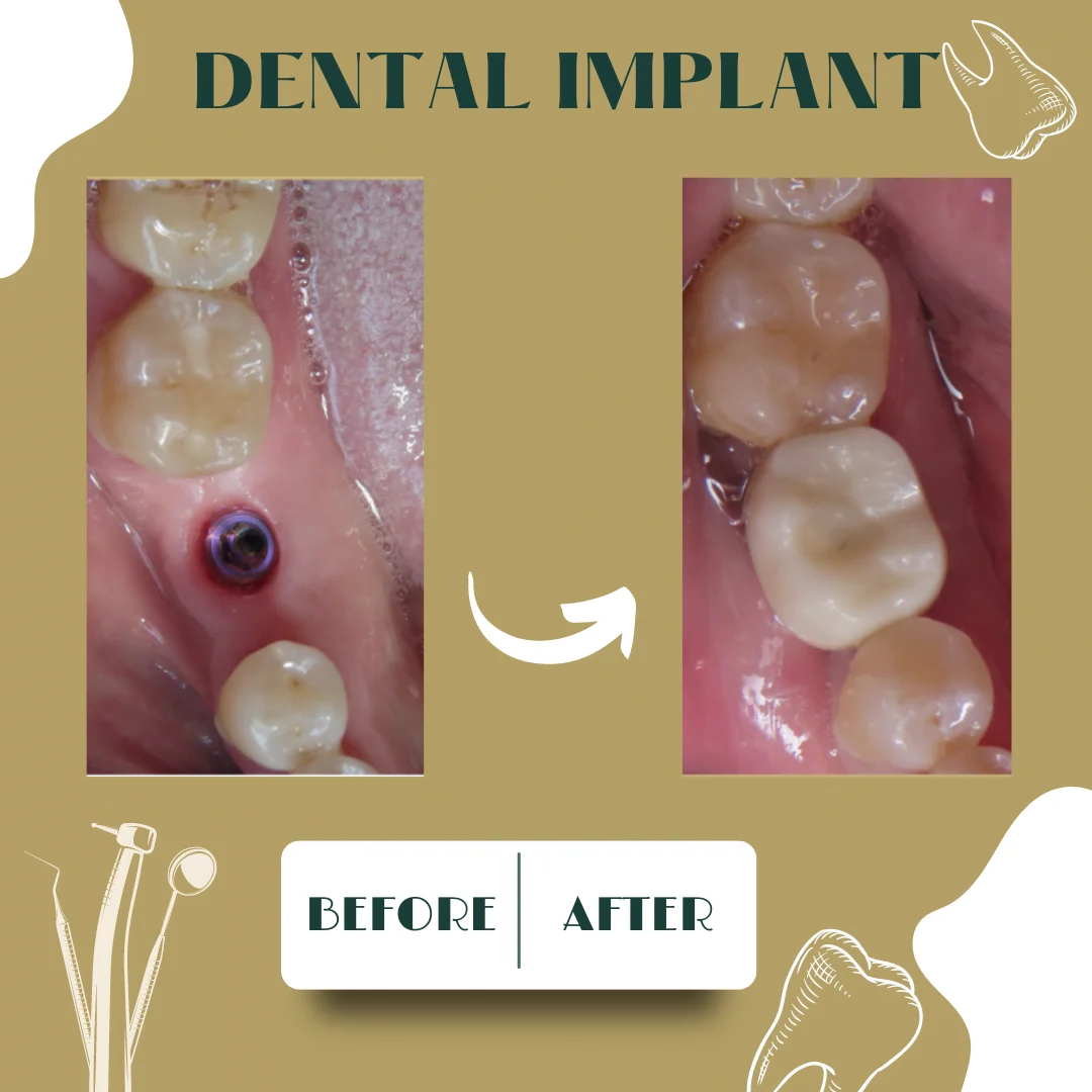 Caso clínico dental 2, antes y después