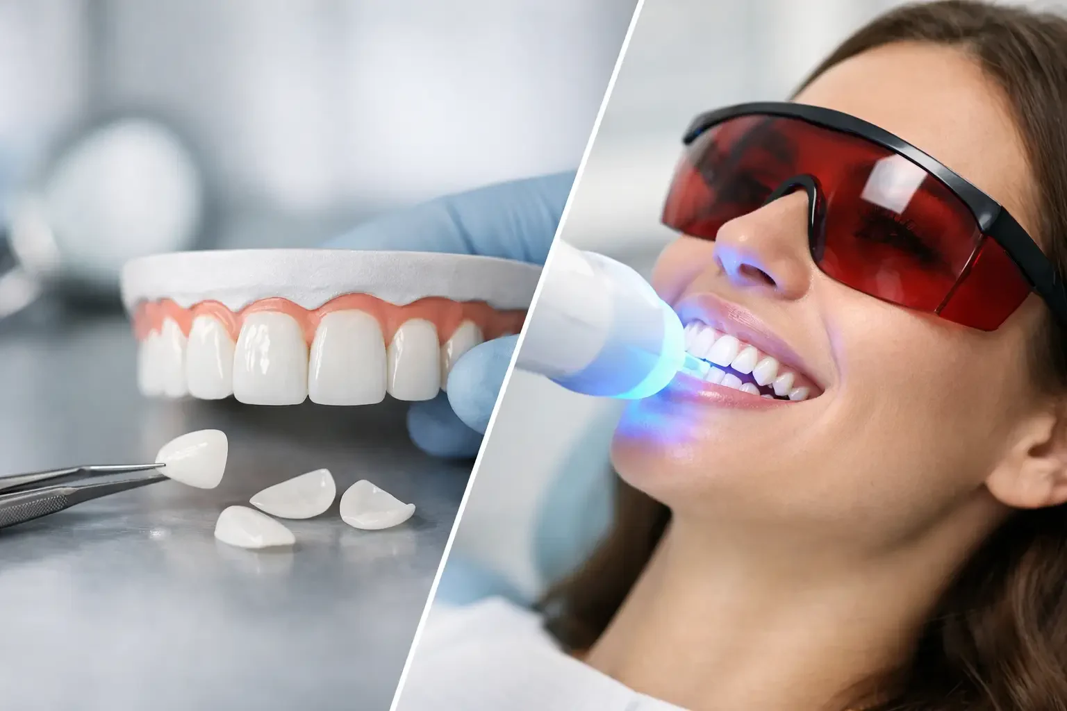 Veneers vs Teeth Whitening: Which Fits You?
