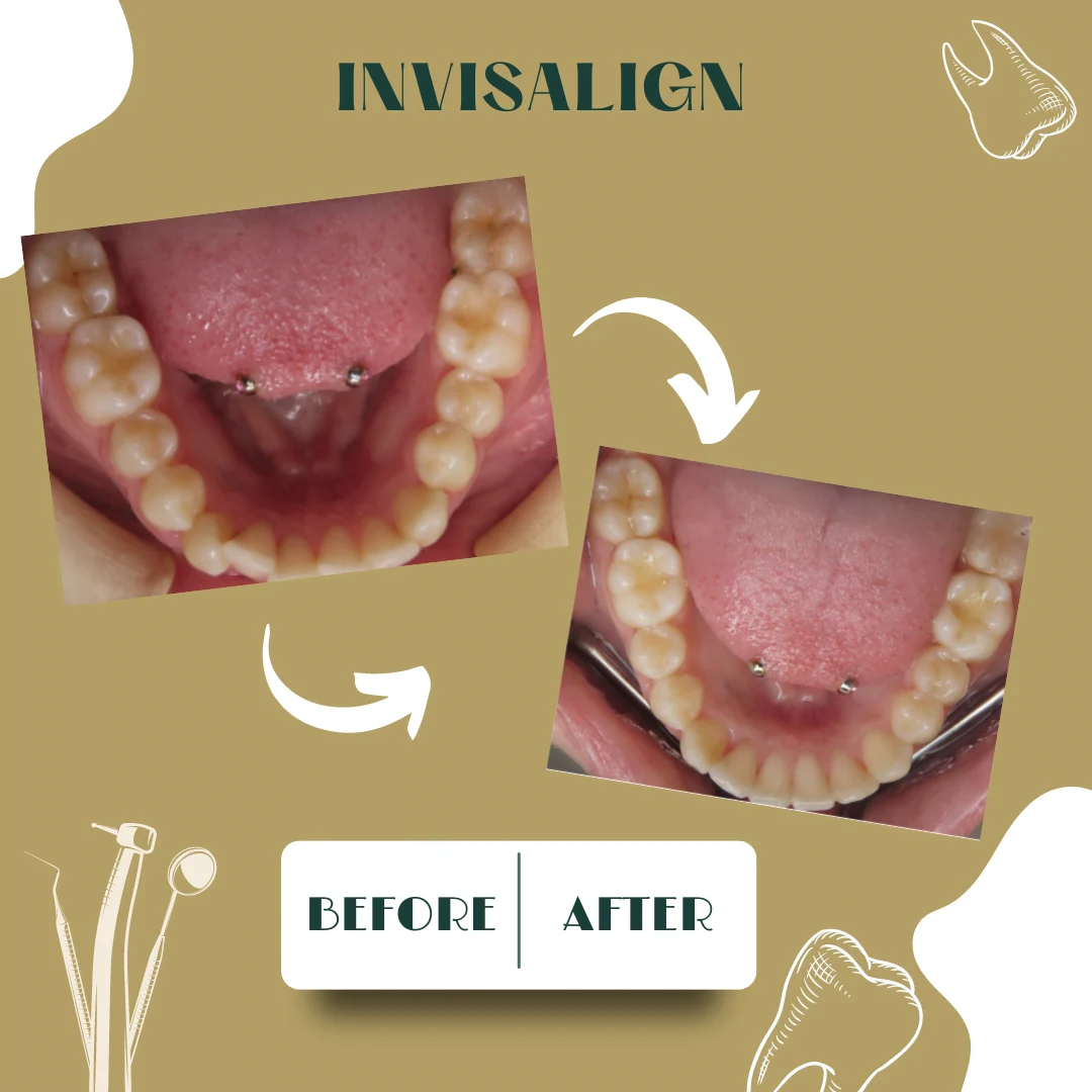 Caso dental, antes y después 13