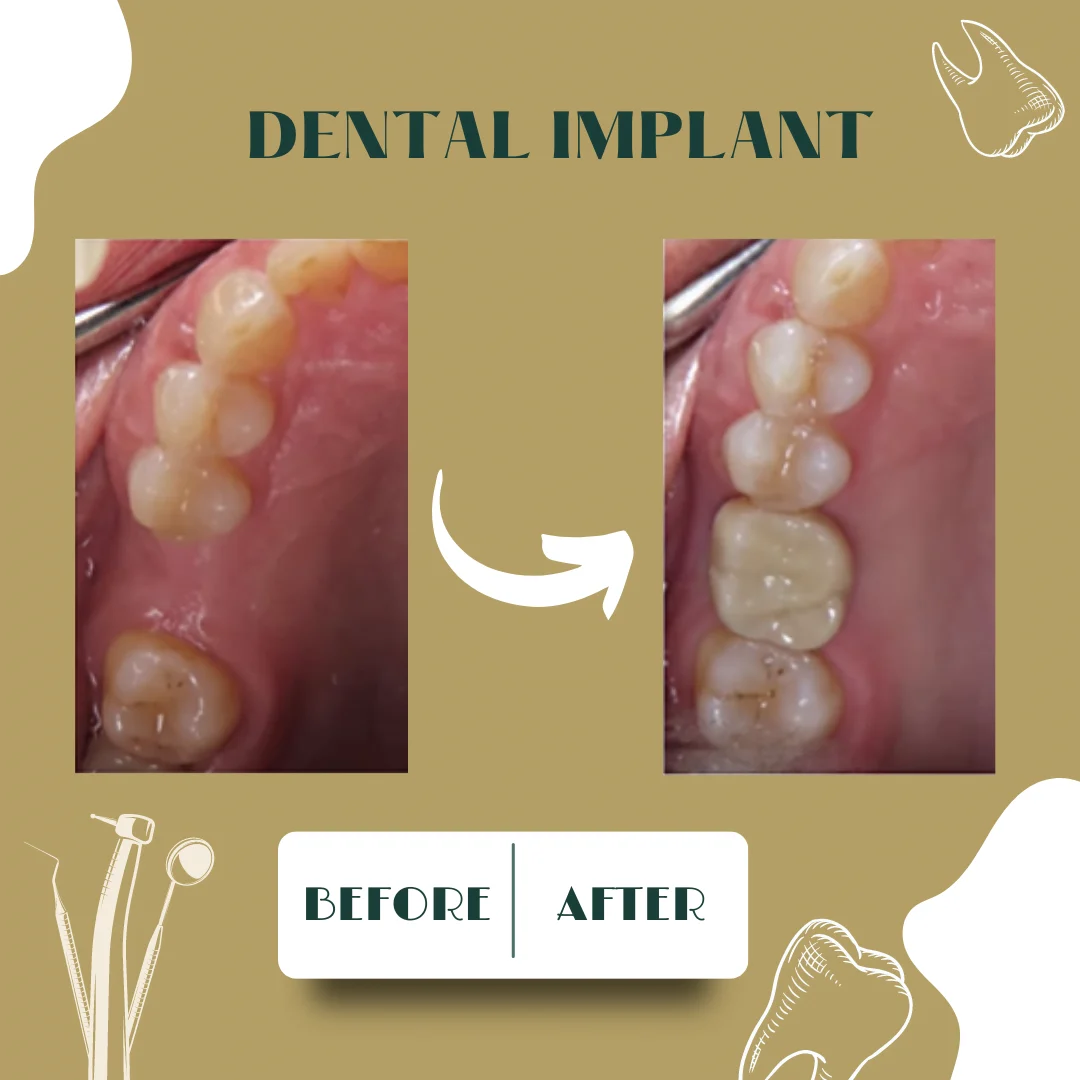 Caso dental, antes y después 4