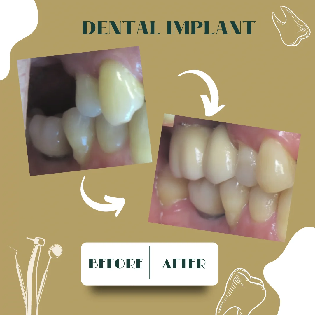 Caso dental, antes y después 22