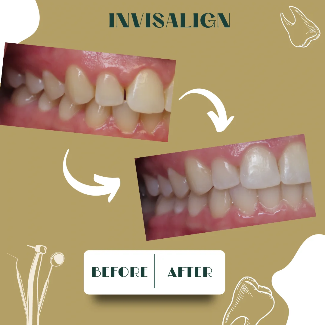 Caso dental, antes y después 18