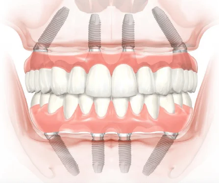 Implantes dentales ALL-ON-4