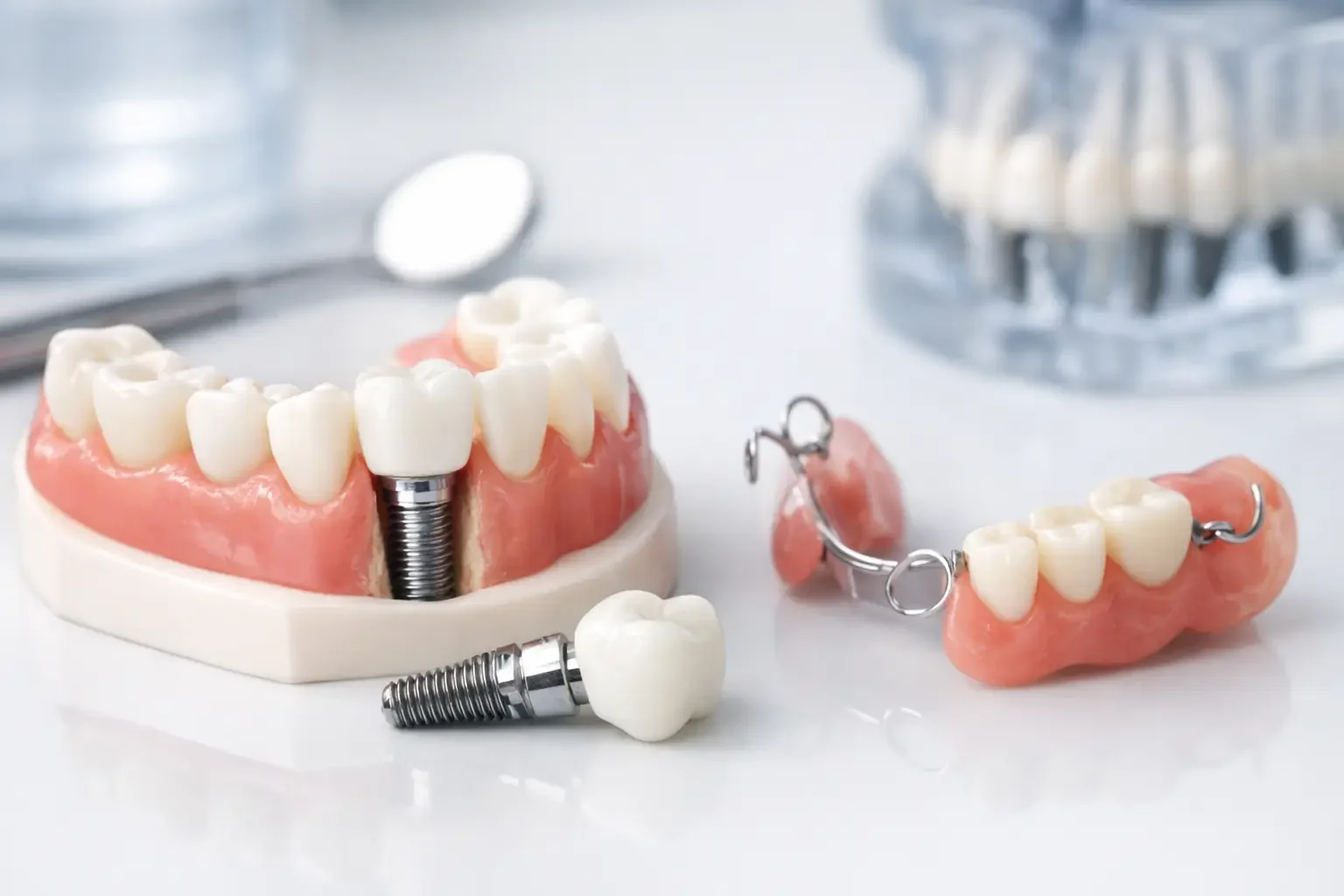 Best Ways to Replace Molars for Lasting Comfort