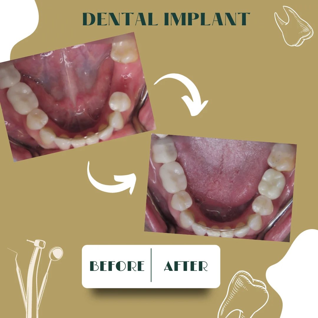 Caso dental, antes y después 30