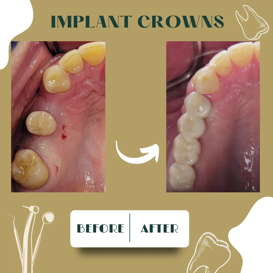 Caso dental, antes y después 12