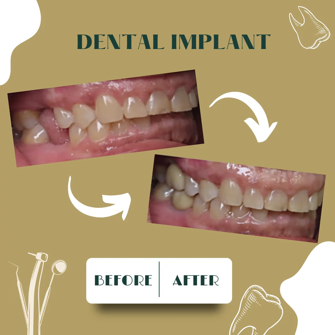 Caso dental, antes y después 5