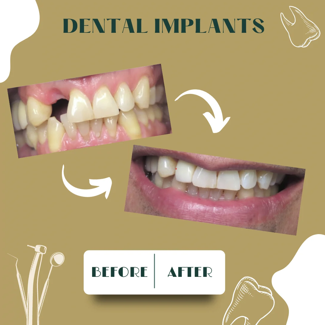 Caso dental, antes y después 14