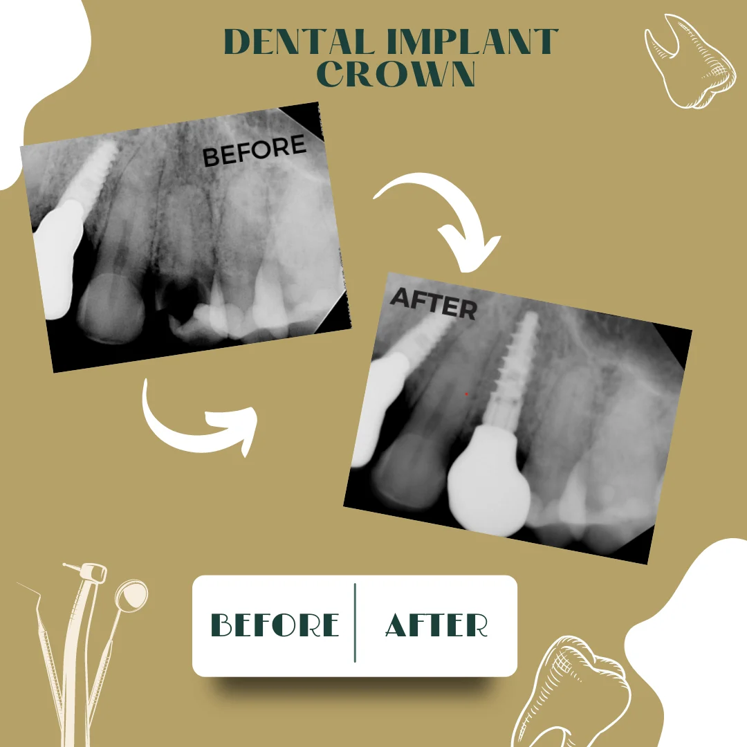 Caso dental, antes y después 17