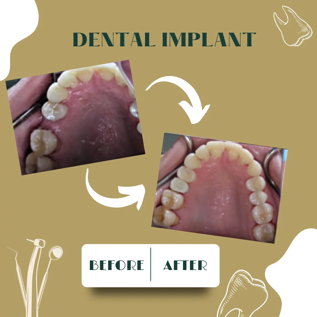 Caso dental, antes y después 3