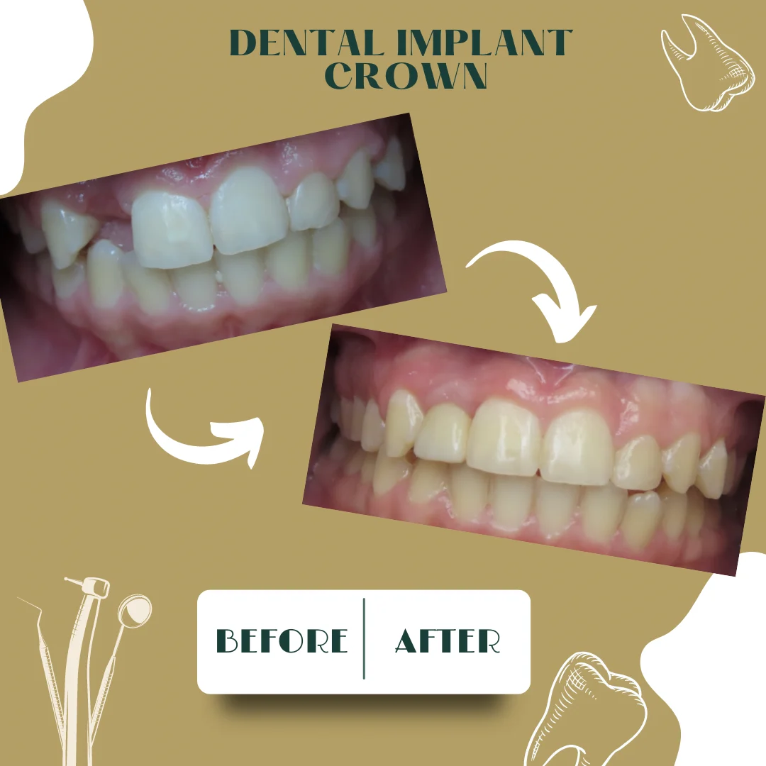 Caso clínico dental 1, antes y después