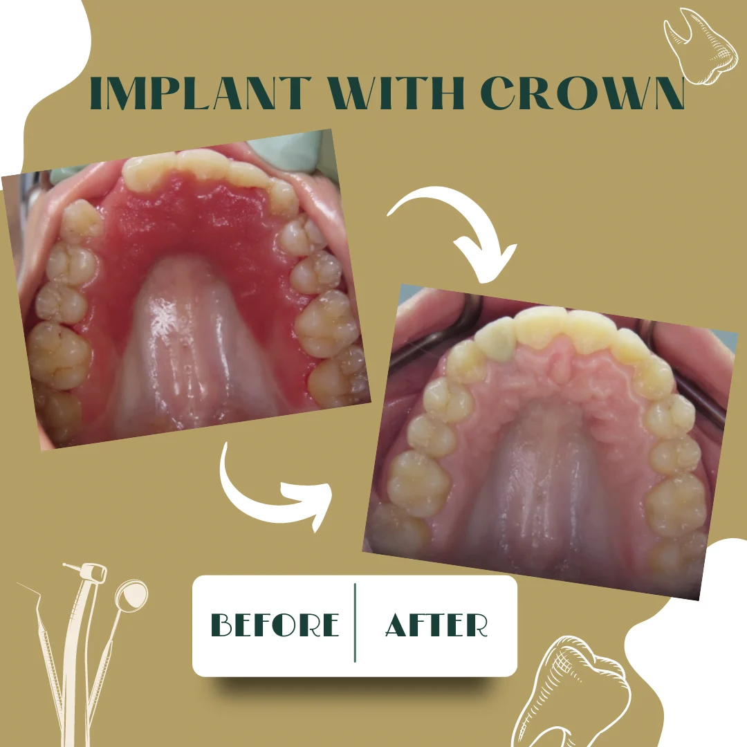 Caso dental, antes y después 8