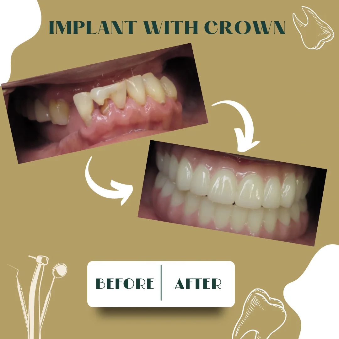 Caso dental, antes y después 11
