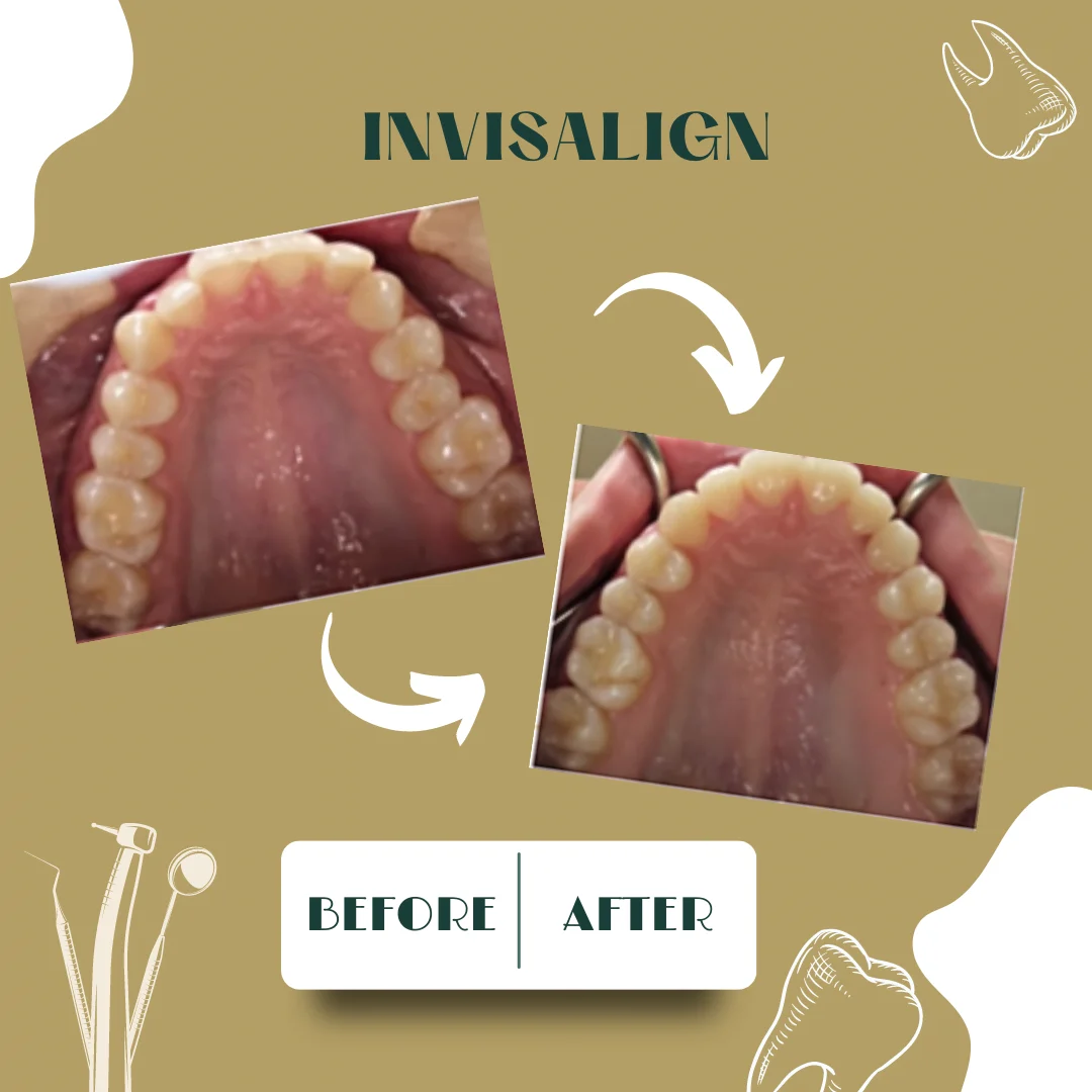 Caso dental, antes y después 7
