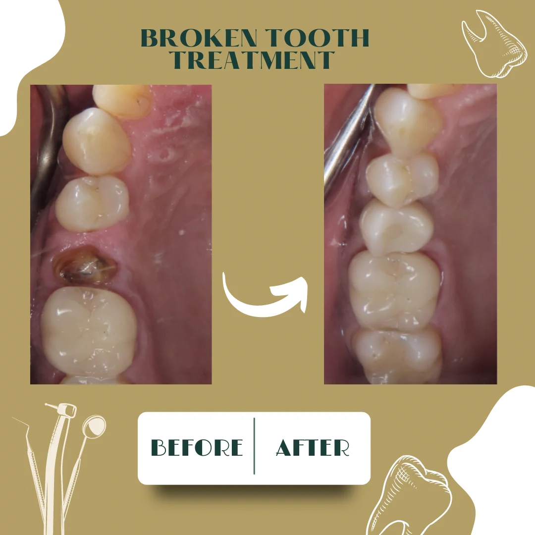 Caso dental, antes y después 15