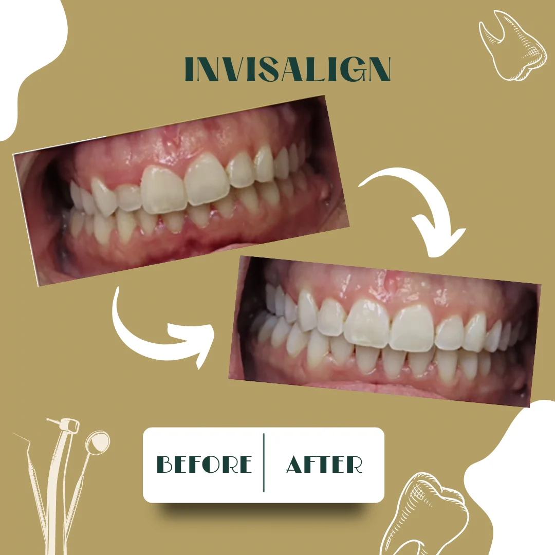 Caso dental, antes y después 2