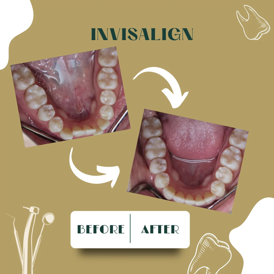 Caso dental, antes y después 6
