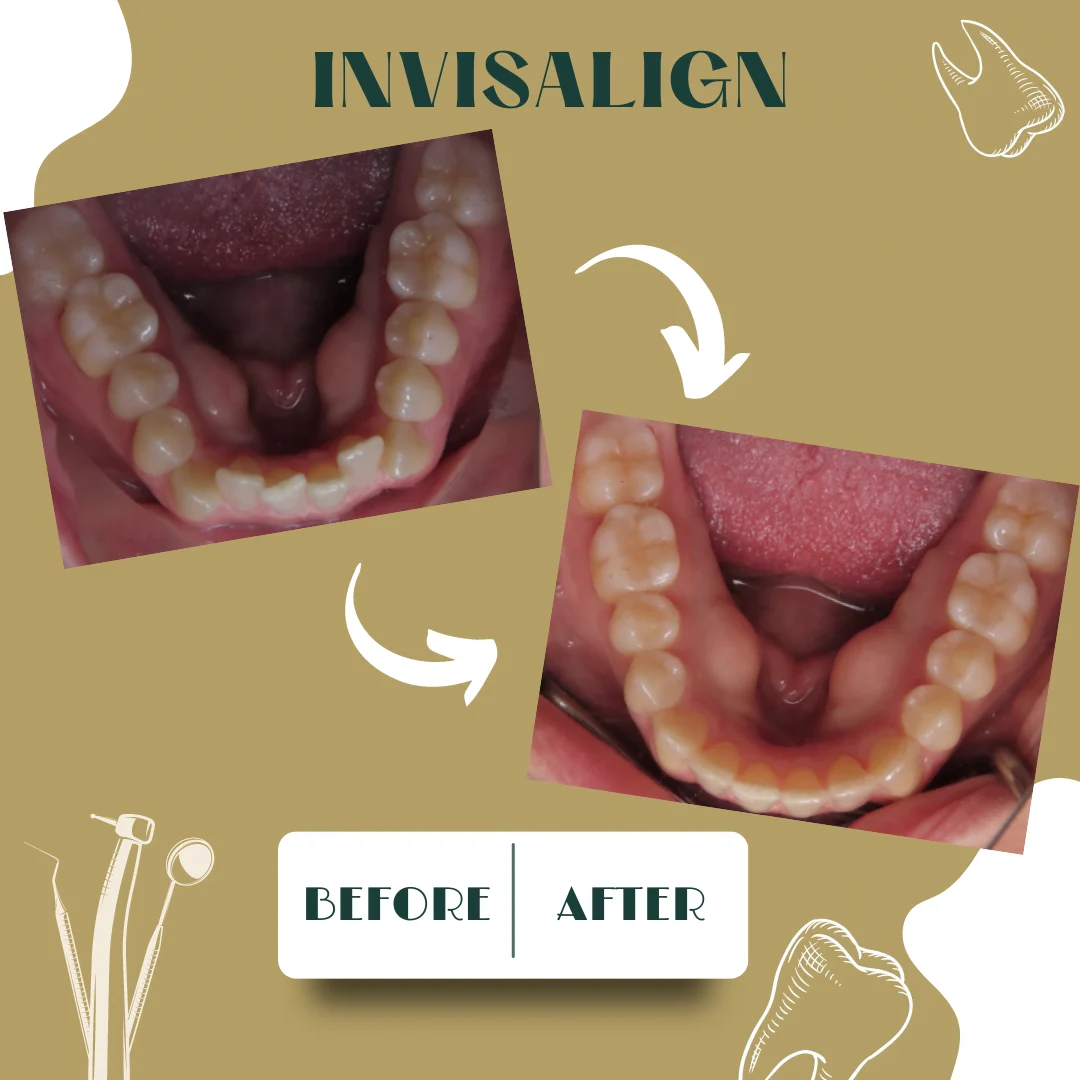Caso dental, antes y después 26