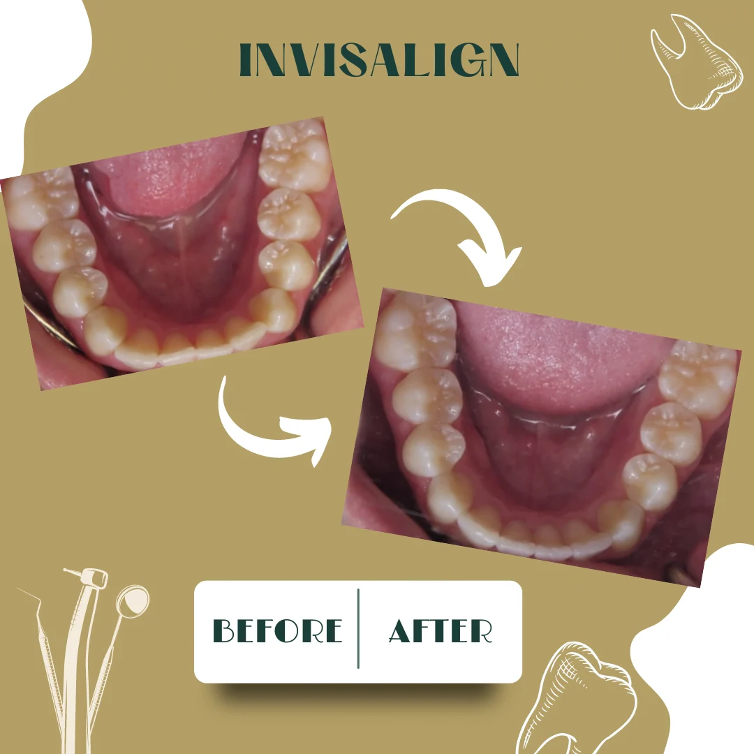 Caso dental, antes y después 10
