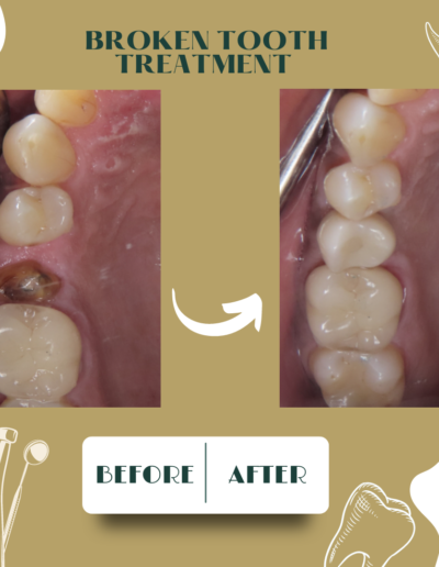 Broken Tooth Treatment Case